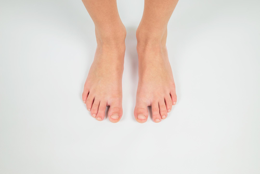 Quando correggere piede piatto Comprendere la sindrome pronatoria